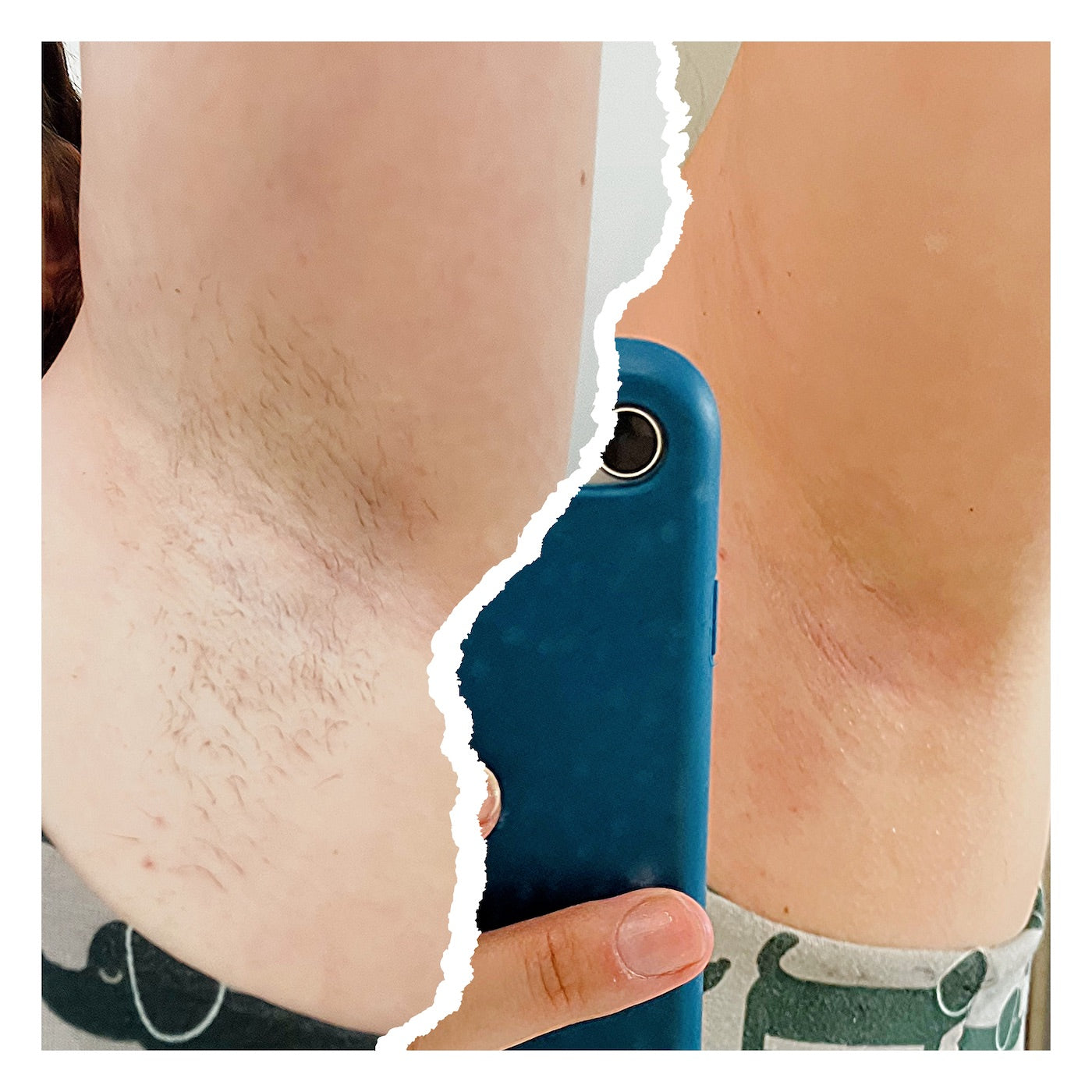 Post-Sugaring Hair Removal: White Spots in Warm Zones – Causes, Treatments & Aftercare